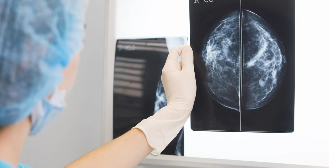 Cáncer de mama: qué mujeres tienen más riesgo de recaída y cómo una nueva terapia puede ayudarlas